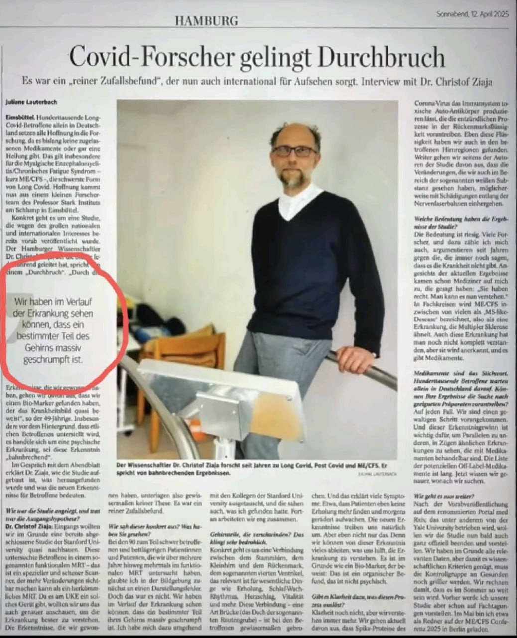 Covid Impfung: Gehirn schrumpft